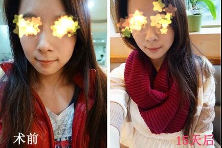 玻尿酸填充法令紋恢復兩周