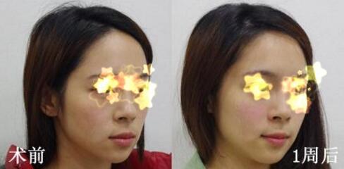 玻尿酸填充法令紋恢復一周了