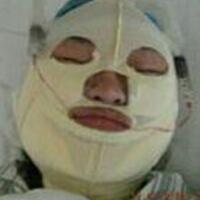 做了磨下頜角手術一年了，手術費用為16800元，已經完全恢復