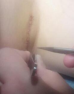 假體隆胸恢復(fù)一周，拆線了