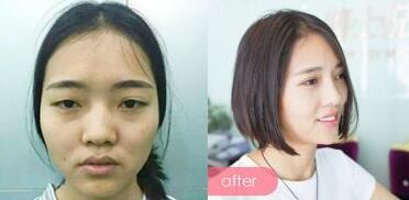 整形前后對(duì)比圖，左邊是微整形前