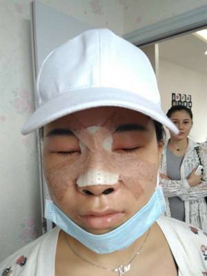 廣州廣美做的假體隆鼻，給大家分享一下手術(shù)前后過程以及對(duì)比照片