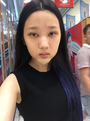 切開雙眼皮+假體隆下巴，我不再是典型的路人甲