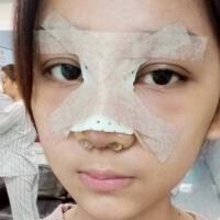 隆鼻整形恢復(fù)日記分享，整形價(jià)格8800元