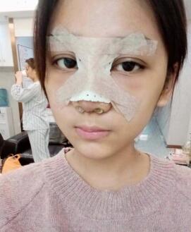 隆鼻整形的第二天