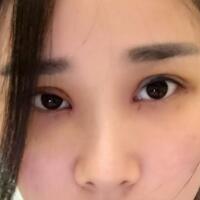 全切雙眼皮價(jià)格6800元，無(wú)神小眼變光彩大雙眼恢復(fù)過(guò)程分享