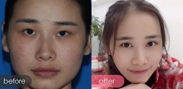 割雙眼皮前后對(duì)比圖