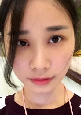 割雙眼皮一周拆線