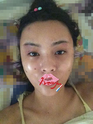 自體脂肪填充全臉，我也可以美美噠