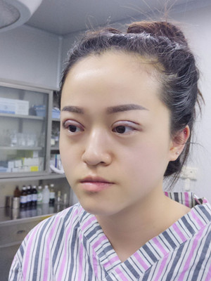 真人記錄了8周全切雙眼皮手術(shù)過程，還有對(duì)比照片喲