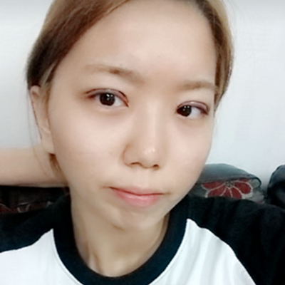 埋線雙眼皮手術(shù)兩個月了，分享術(shù)后恢復(fù)的照片呢~