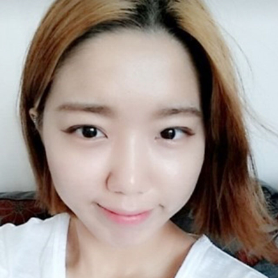 埋線雙眼皮手術(shù)兩個月了，分享術(shù)后恢復(fù)的照片呢~