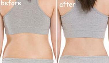 吸脂減肥前后對(duì)比圖