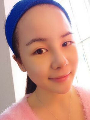 鼻部綜合整形真實(shí)案例，前后對(duì)比圖奉上