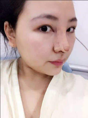 我的隆鼻整形恢復(fù)那些小事