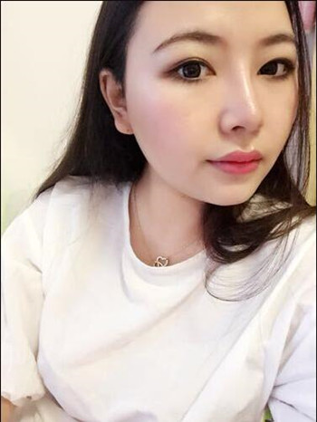 我的隆鼻整形恢復(fù)那些小事