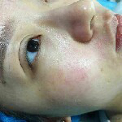 光子嫩膚快一個月了，分享手術過程和前后對比果圖片哦~