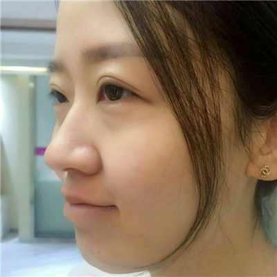 光子嫩膚快一個月了，分享手術過程和前后對比果圖片哦~