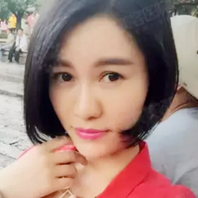 玻尿酸注射鼻子+下巴+太陽穴+蘋果肌術(shù)后一個月的果照片~