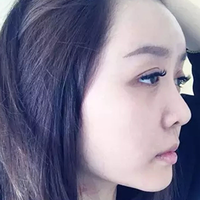 玻尿酸注射隆鼻、自體脂肪豐太陽(yáng)穴跟玻尿酸墊下巴兩個(gè)月果照片~