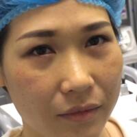 去眼袋手術多少錢？做了激光去眼袋價格5800元，恢復很好