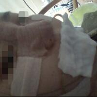 下頜骨整形價(jià)格15000元，整形前后氣質(zhì)容貌變化很大