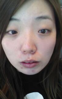 下頜骨整形前的照片