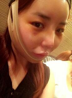 下頜骨整形第九天