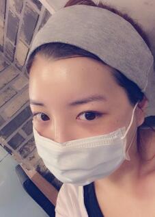 下頜骨整形第十二天，拆線的時(shí)候醫(yī)生手法一如既往的嫻熟輕巧