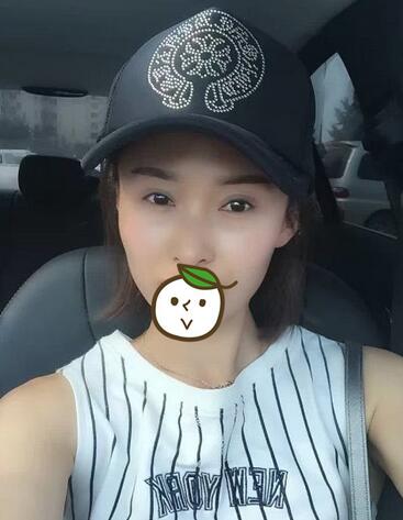 北京麗星雙眼皮修復(fù)半年了