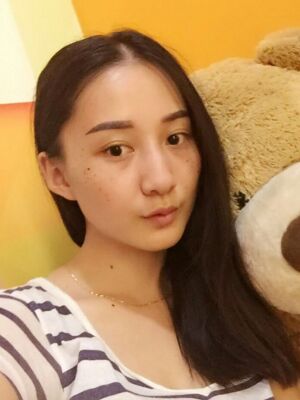 激光祛斑前后對比圖，雀斑全都沒啦