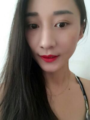 激光祛斑前后對比圖，雀斑全都沒啦