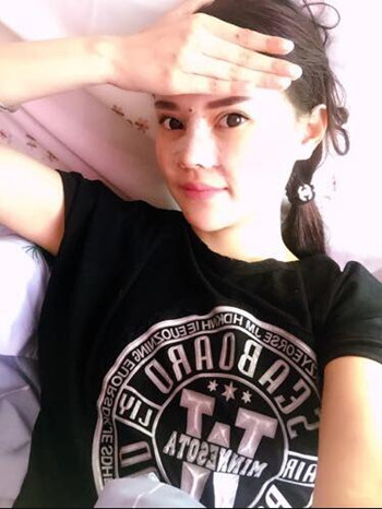 我的膨體隆鼻恢復(fù)的那些日子 內(nèi)有果對(duì)比圖