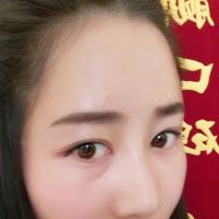 自體脂肪填充太陽穴豐額頭親身經(jīng)歷，多過程恢復(fù)圖分享