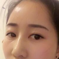 自體脂肪填充太陽穴豐額頭親身經(jīng)歷，多過程恢復(fù)圖分享