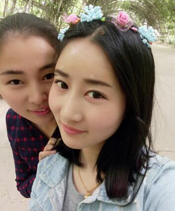 自體脂肪填充太陽穴+額頭第五天