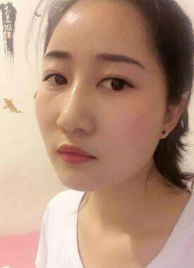 自體脂肪填充太陽穴+額頭一個半月