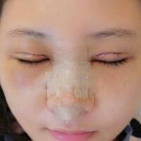 在昆明做了眼睛和鼻子整形，雖然花費(fèi)了16000元，但人美了就值！