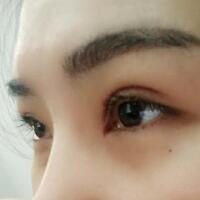 割雙眼皮手術(shù)價(jià)格3200元，單眼皮變雙眼皮，去皮去脂，美美的~