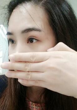 割雙眼皮半個(gè)月