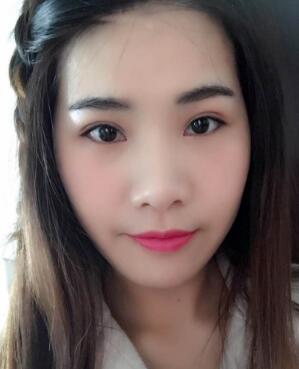 割雙眼皮兩個(gè)月，雙眼皮已經(jīng)完全穩(wěn)定