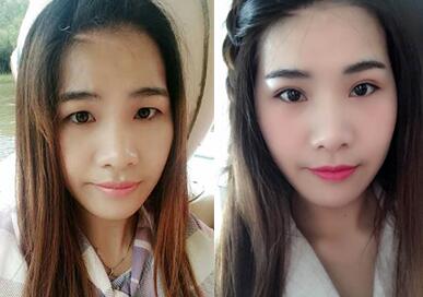 割雙眼皮手術(shù)前后對(duì)比圖