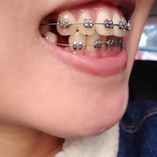 牙齒矯正前后對(duì)比照真實(shí)過程分享終于不是齙牙妹了哦