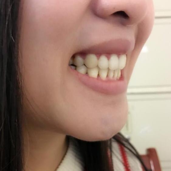 牙齒矯正前后對(duì)比照真實(shí)過程分享終于不是齙牙妹了哦