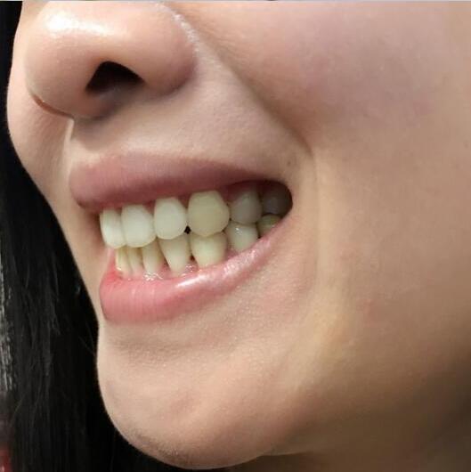 牙齒矯正前后對(duì)比照真實(shí)過程分享終于不是齙牙妹了哦