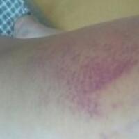 水動(dòng)力吸脂減肥瘦大腿真實(shí)經(jīng)歷，抽脂后對(duì)比照片分享