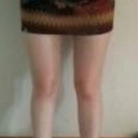 水動(dòng)力吸脂減肥瘦大腿真實(shí)經(jīng)歷，抽脂后對(duì)比照片分享