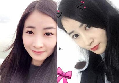 隆鼻前后的對(duì)比照片