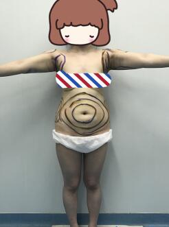 吸脂減肥前照片