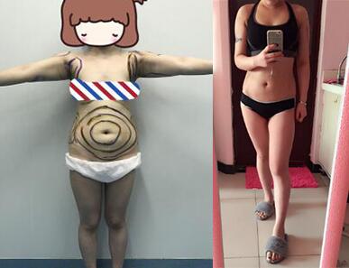 吸脂減肥瘦腰腹+手臂術(shù)后果對(duì)比圖